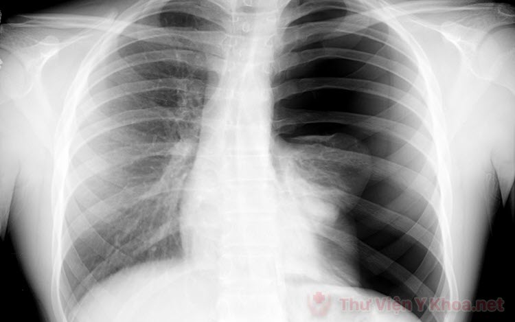 Nhận biết và chuẩn đoán tràn khí màng phổi