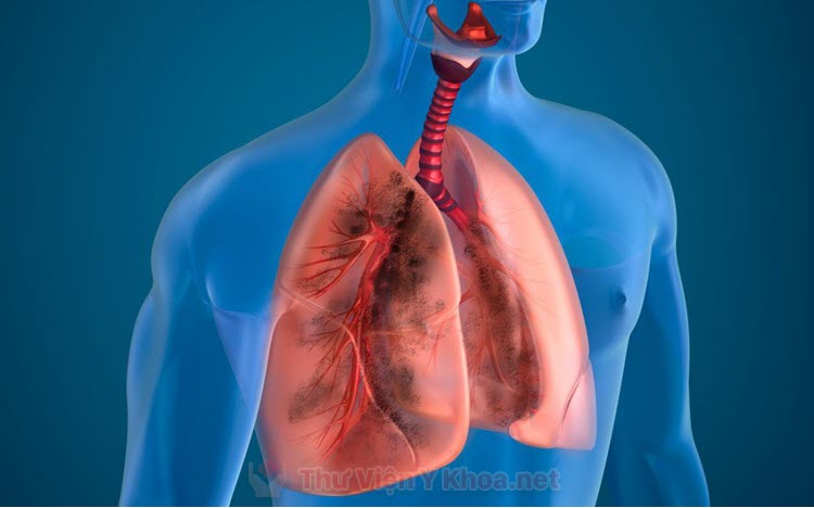 Cách điều trị tràn mủ màng phổi